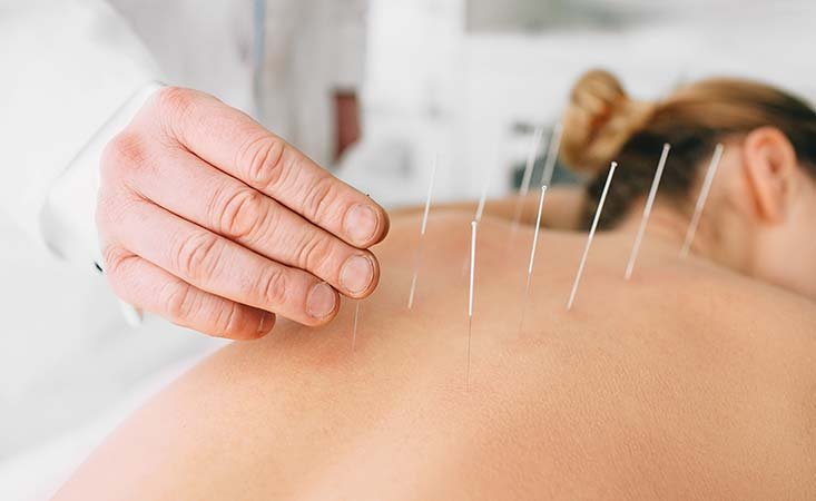 accupuncture-733×450 accupuncture-733x450