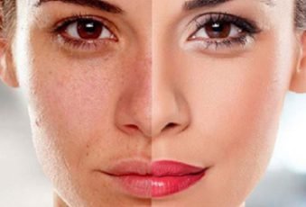 Vitality-and-lightening-treatment-2 Vitality-and-lightening-treatment-2