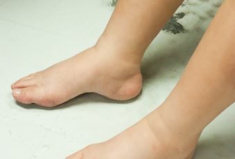 swollen Human feet